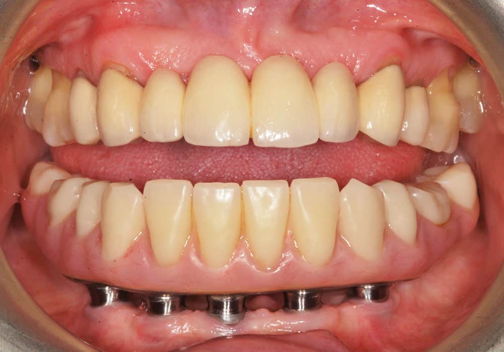 prothese complete sur implants