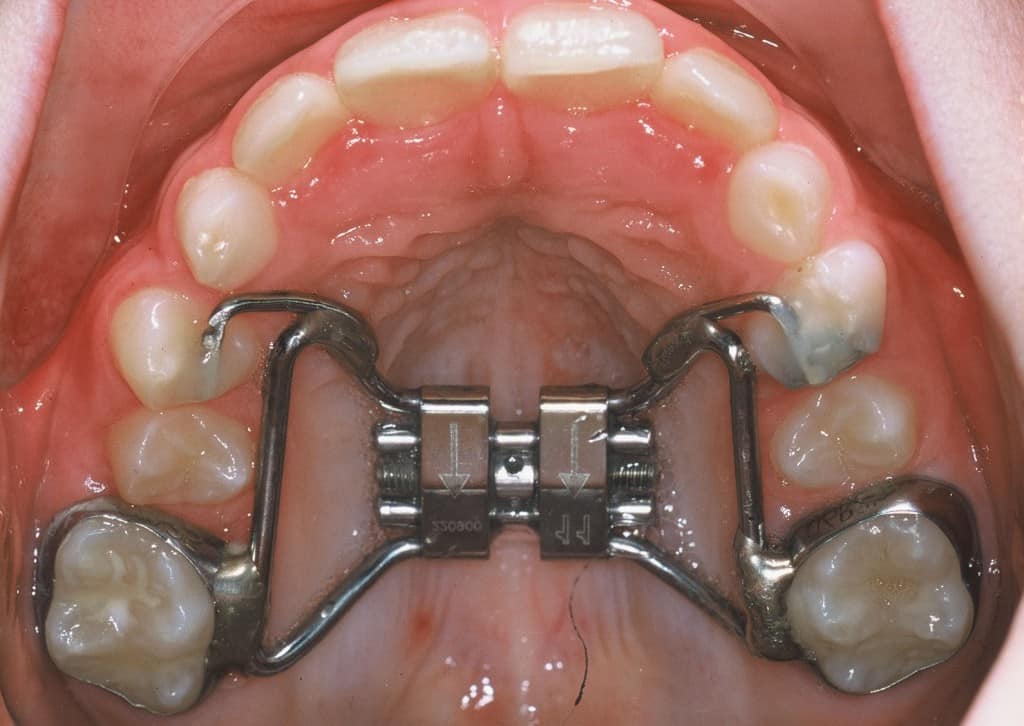 Vérin orthodontique