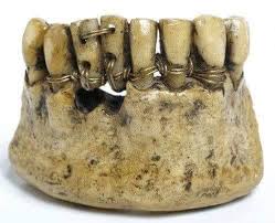 5. Prothésiste dentaire et denturologie : une complémentarité au service de la santé 4 Prothèses dentaires antiquité